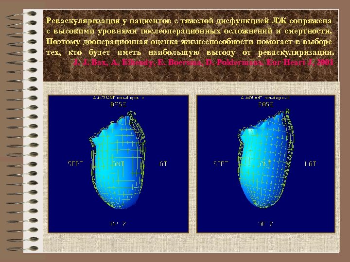 Реваскуляризация у пациентов с тяжелой дисфункцией ЛЖ сопряжена с высокими уровнями послеоперационных осложнений и