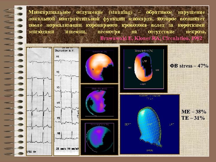 Миокардиальное оглушение (stunning) – обратимое нарушение локальной контрактильной функции миокарда, которое возникает после нормализации
