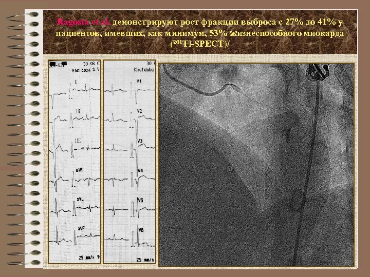 Ragosta et al. демонстрируют рост фракции выброса с 27% до 41% у пациентов, имевших,