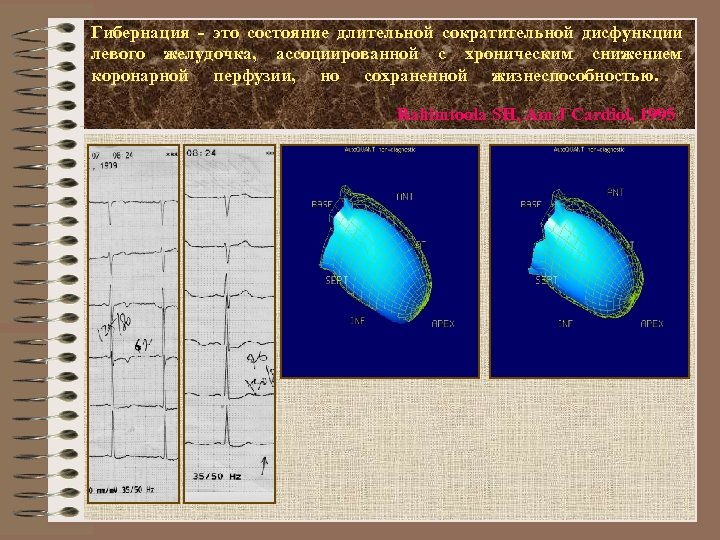 Гибернация - это состояние длительной сократительной дисфункции левого желудочка, ассоциированной с хроническим снижением коронарной
