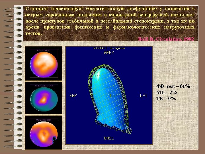 Станнинг пролонгирует сократительную дисфункцию у пациентов с острым коронарным синдромом и коронарной реперфузией, возникает