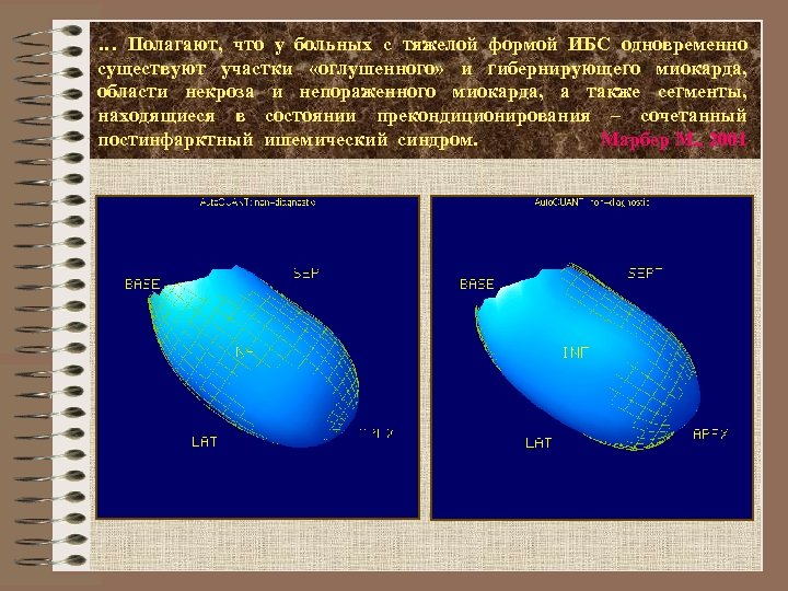 … Полагают, что у больных с тяжелой формой ИБС одновременно существуют участки «оглушенного» и