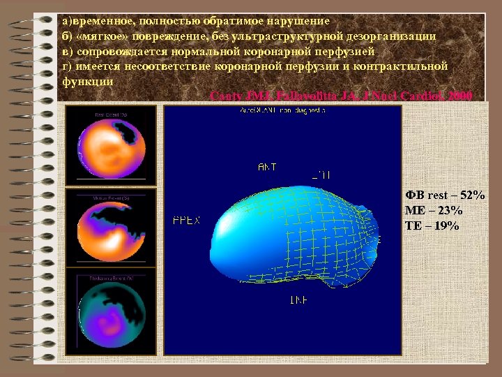 а)временное, полностью обратимое нарушение б) «мягкое» повреждение, без ультраструктурной дезорганизации в) сопровождается нормальной коронарной