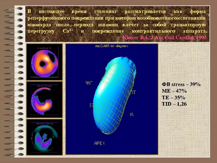 В настоящее время станнинг рассматривается как форма реперфузионного повреждения при котором возобновление оксигенации миокарда