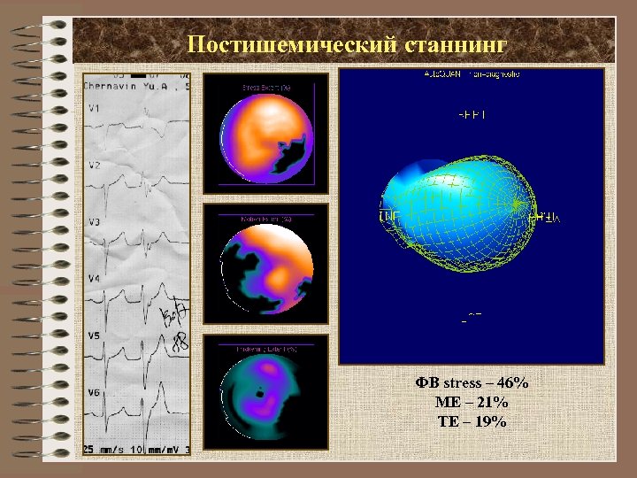 Постишемический станнинг ФВ stress – 46% ME – 21% TE – 19% 