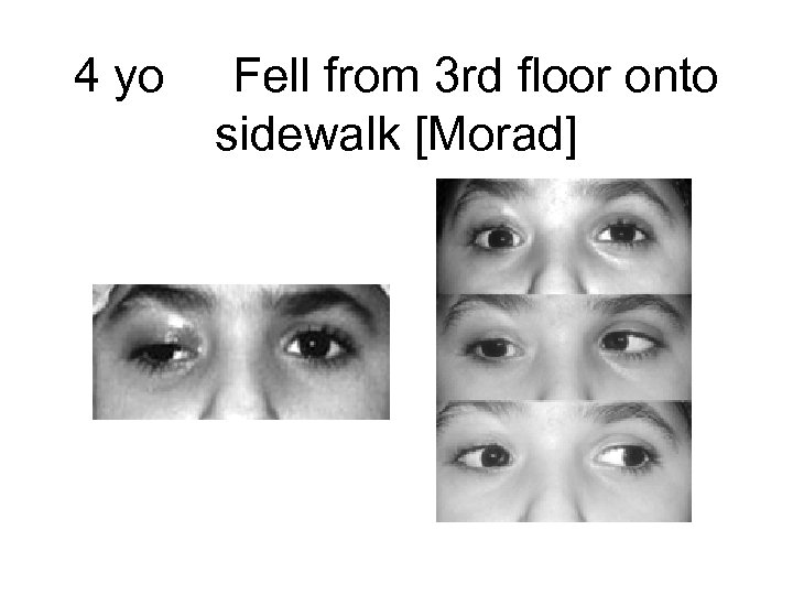 4 yo Fell from 3 rd floor onto sidewalk [Morad] 