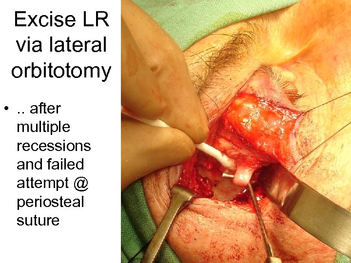 Excise LR via lateral orbitotomy • . . after multiple recessions and failed attempt