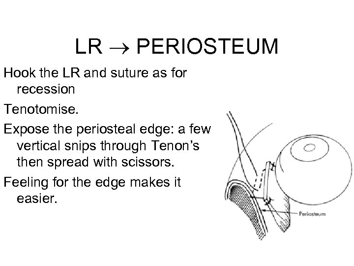 LR PERIOSTEUM Hook the LR and suture as for recession Tenotomise. Expose the periosteal