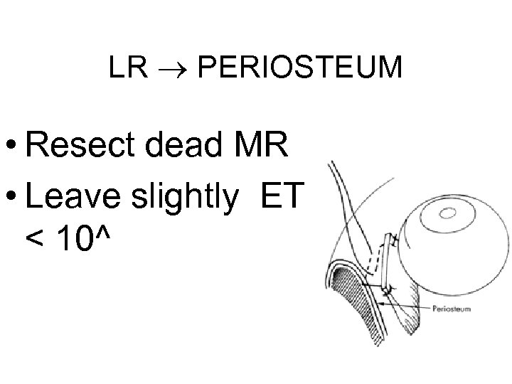 LR PERIOSTEUM • Resect dead MR • Leave slightly ET < 10^ 