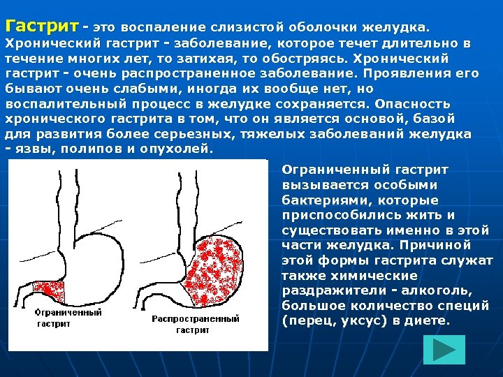 Гастрит - это воспаление слизистой оболочки желудка. Хронический гастрит - заболевание, которое течет длительно