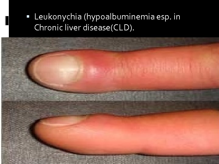  Leukonychia (hypoalbuminemia esp. in Chronic liver disease(CLD). 