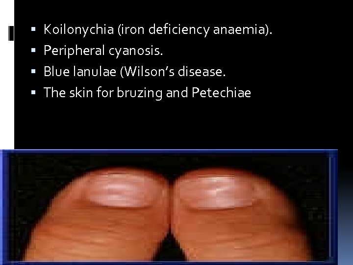  Koilonychia (iron deficiency anaemia). Peripheral cyanosis. Blue lanulae (Wilson’s disease. The skin for