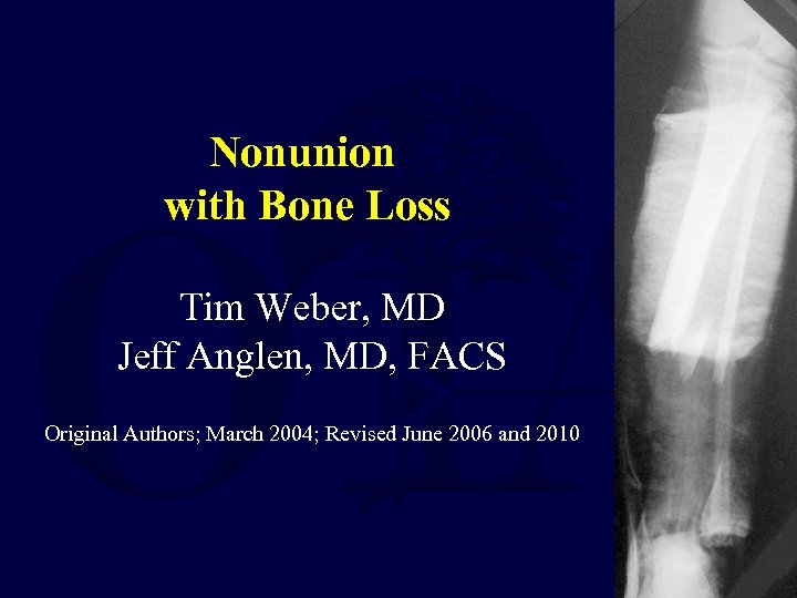 Nonunion with Bone Loss Tim Weber, MD Jeff Anglen, MD, FACS Original Authors; March