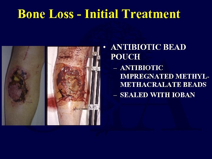 Bone Loss - Initial Treatment • ANTIBIOTIC BEAD POUCH – ANTIBIOTIC IMPREGNATED METHYLMETHACRALATE BEADS