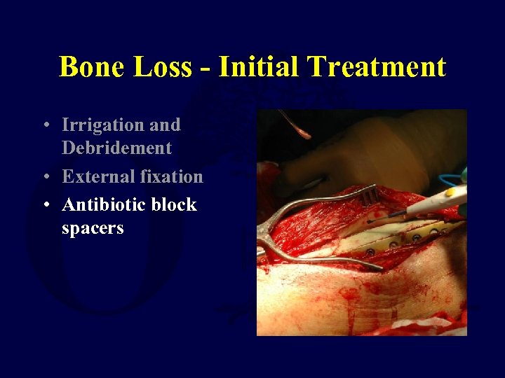 Bone Loss - Initial Treatment • Irrigation and Debridement • External fixation • Antibiotic