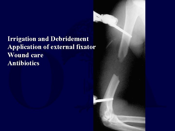 Irrigation and Debridement Application of external fixator Wound care Antibiotics 