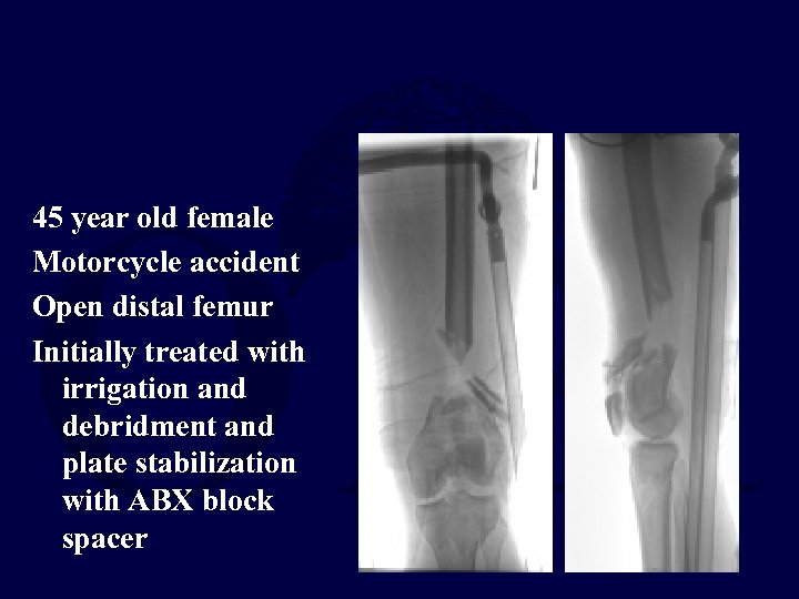 45 year old female Motorcycle accident Open distal femur Initially treated with irrigation and