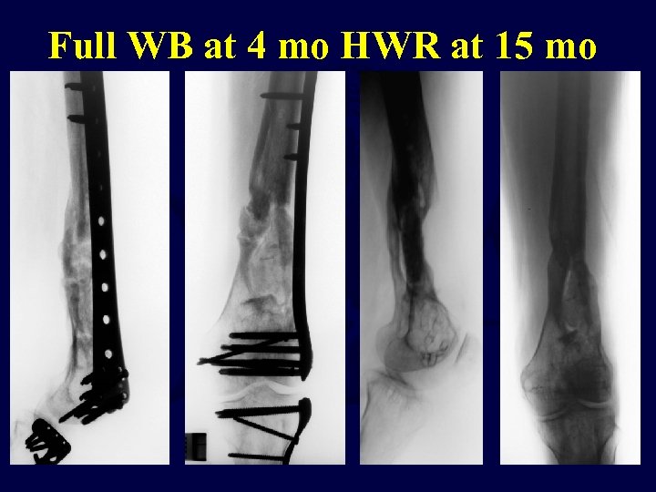 Full WB at 4 mo HWR at 15 mo 