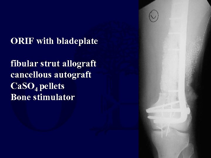 ORIF with bladeplate fibular strut allograft cancellous autograft Ca. SO 4 pellets Bone stimulator