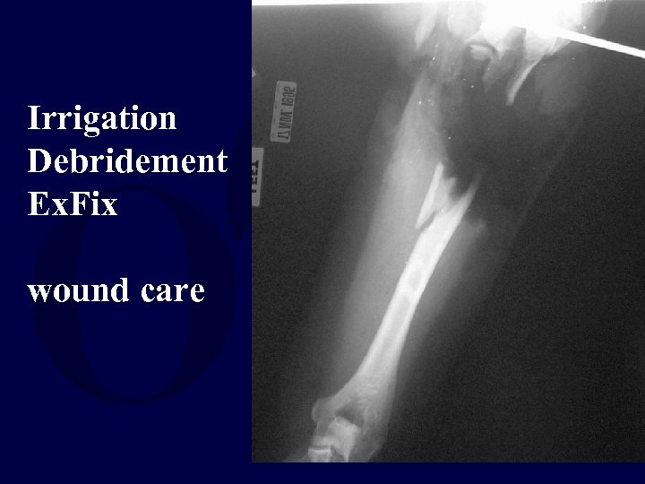 Irrigation Debridement Ex. Fix wound care 