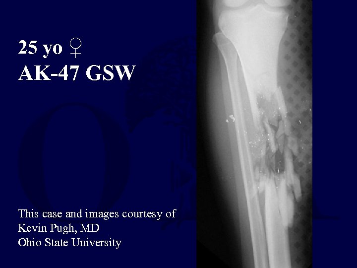 25 yo ♀ AK-47 GSW This case and images courtesy of Kevin Pugh, MD