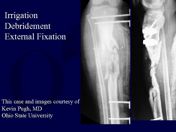 Irrigation Debridement External Fixation This case and images courtesy of Kevin Pugh, MD Ohio