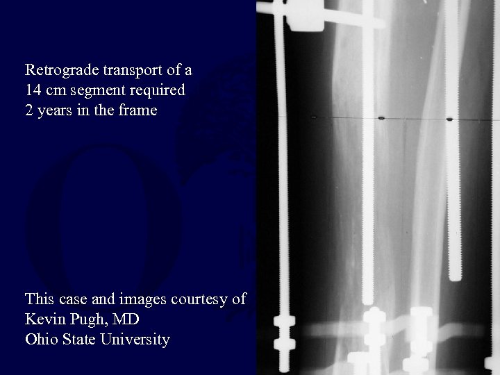 Retrograde transport of a 14 cm segment required 2 years in the frame This