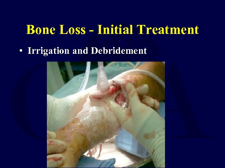 Bone Loss - Initial Treatment • Irrigation and Debridement 