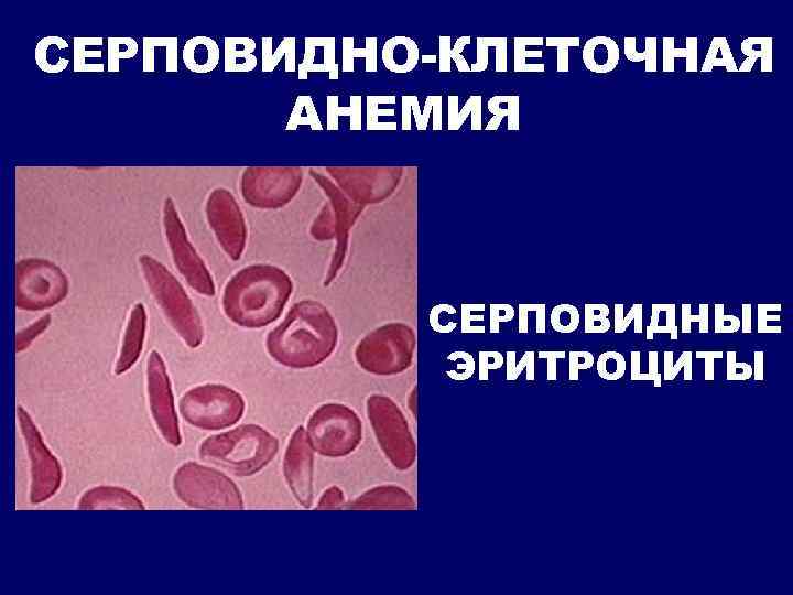 Серповидноклеточная анемия рецессивный