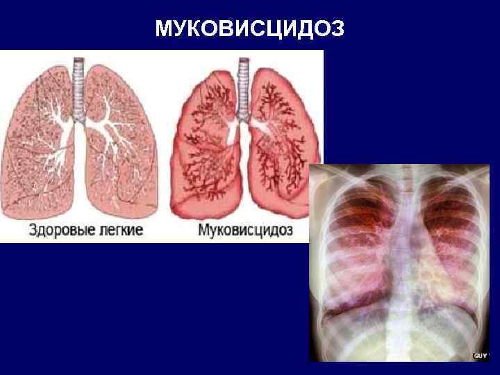 МУКОВИСЦИДОЗ 