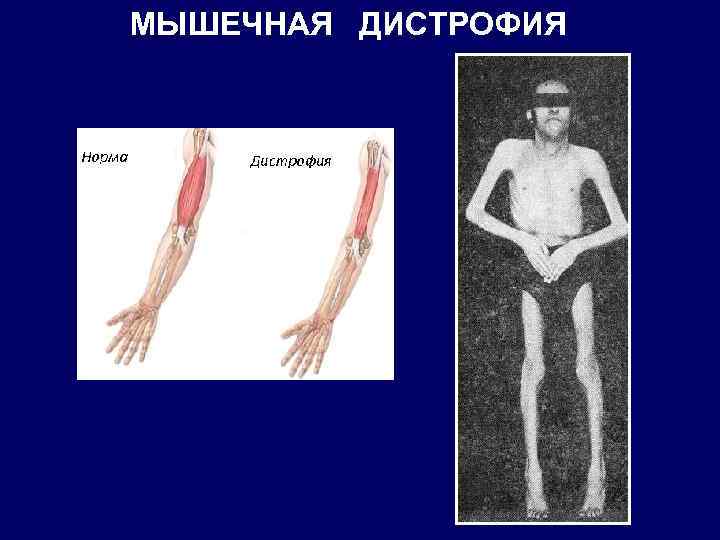 МЫШЕЧНАЯ ДИСТРОФИЯ 