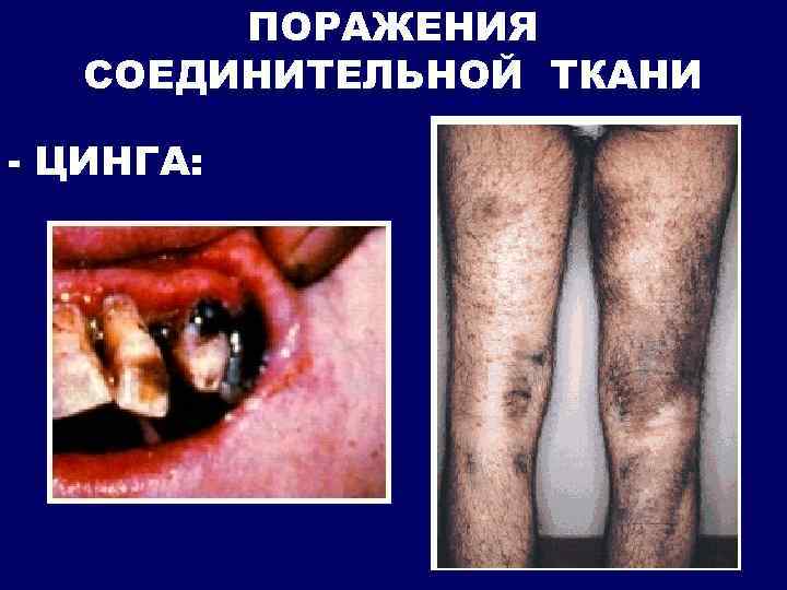 ПОРАЖЕНИЯ СОЕДИНИТЕЛЬНОЙ ТКАНИ - ЦИНГА: 