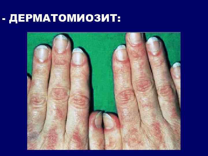 - ДЕРМАТОМИОЗИТ: 