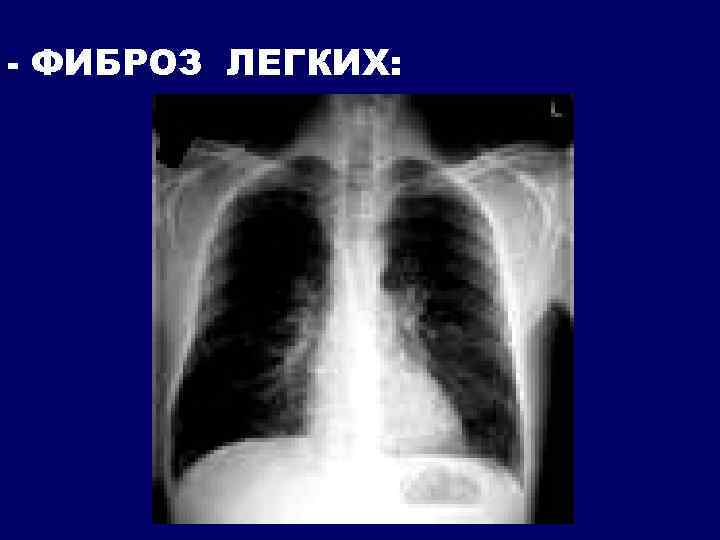- ФИБРОЗ ЛЕГКИХ: 