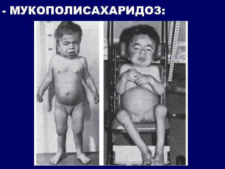 - МУКОПОЛИСАХАРИДОЗ: 