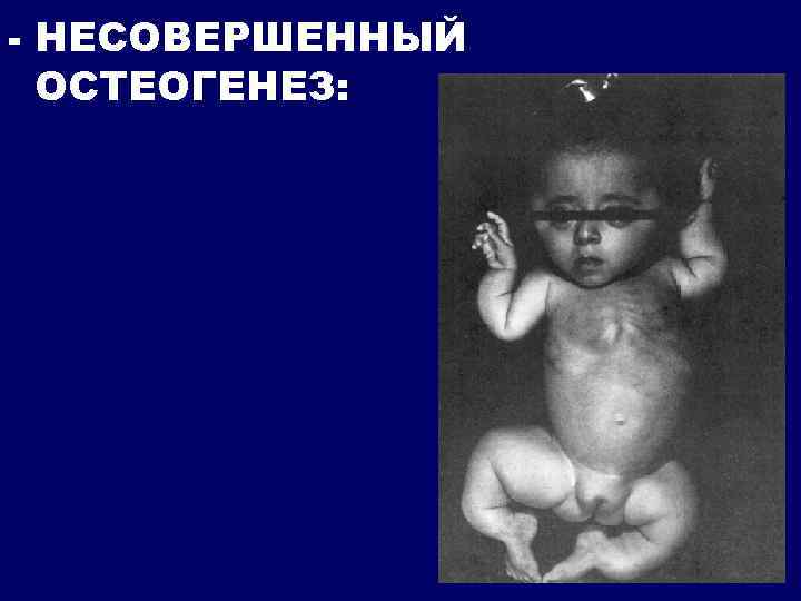 - НЕСОВЕРШЕННЫЙ ОСТЕОГЕНЕЗ: 