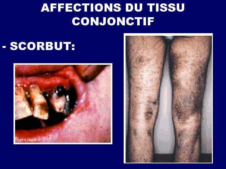 AFFECTIONS DU TISSU CONJONCTIF - SCORBUT: 