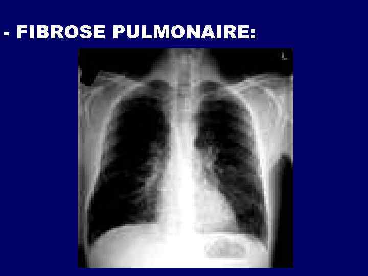 - FIBROSE PULMONAIRE: 