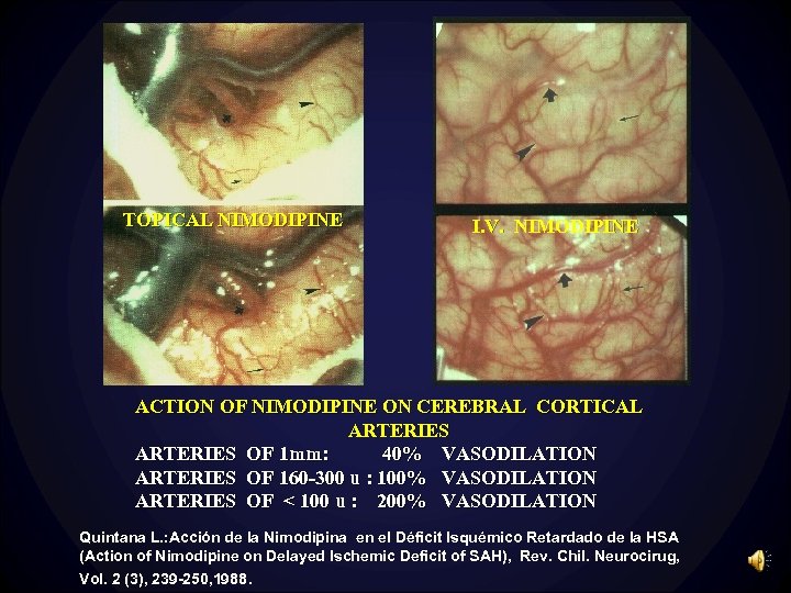 TOPICAL NIMODIPINE I. V. NIMODIPINE ACTION OF NIMODIPINE ON CEREBRAL CORTICAL ARTERIES OF 1