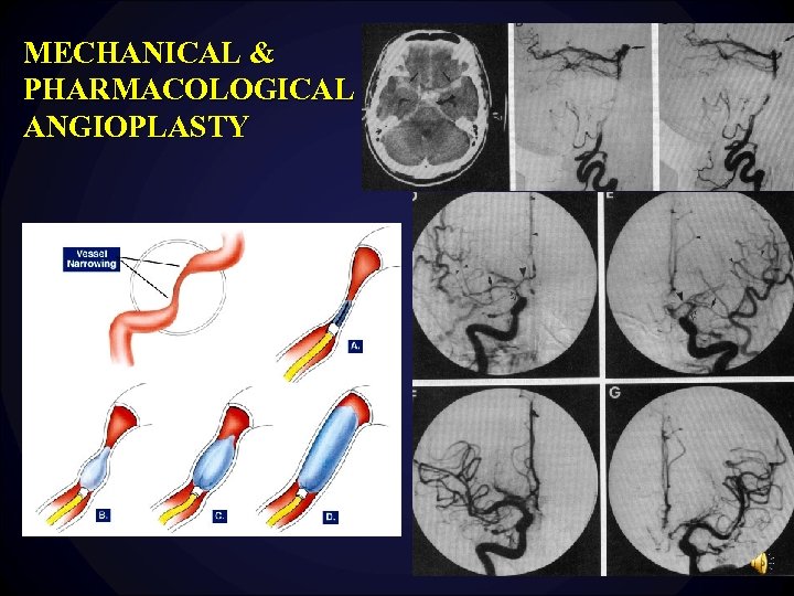 MECHANICAL & PHARMACOLOGICAL ANGIOPLASTY 