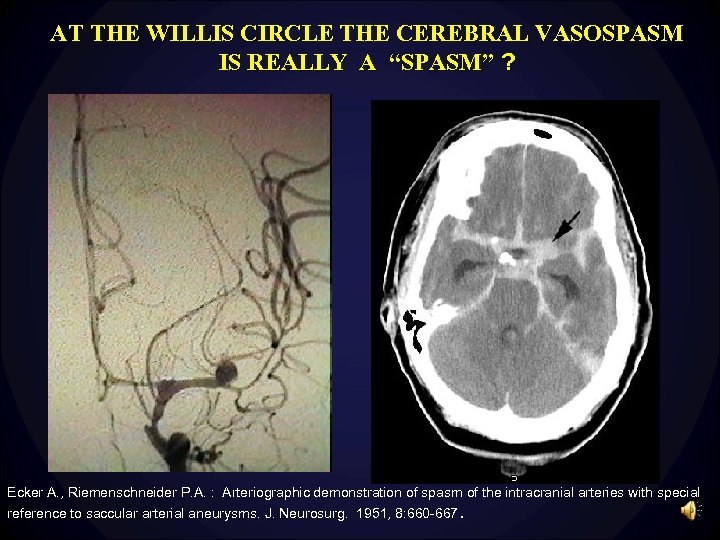 AT THE WILLIS CIRCLE THE CEREBRAL VASOSPASM IS REALLY A “SPASM” ? Ecker A.