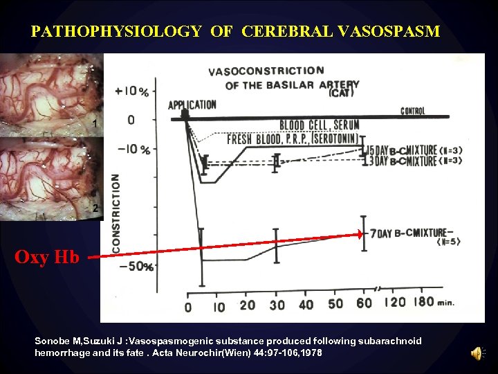 PATHOPHYSIOLOGY OF CEREBRAL VASOSPASM Oxy Hb Sonobe M, Suzuki J : Vasospasmogenic substance produced