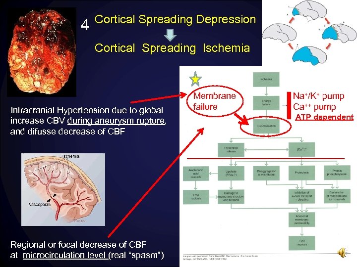 4 Cortical Spreading Depression Cortical Spreading Ischemia Intracranial Hypertension due to global increase CBV