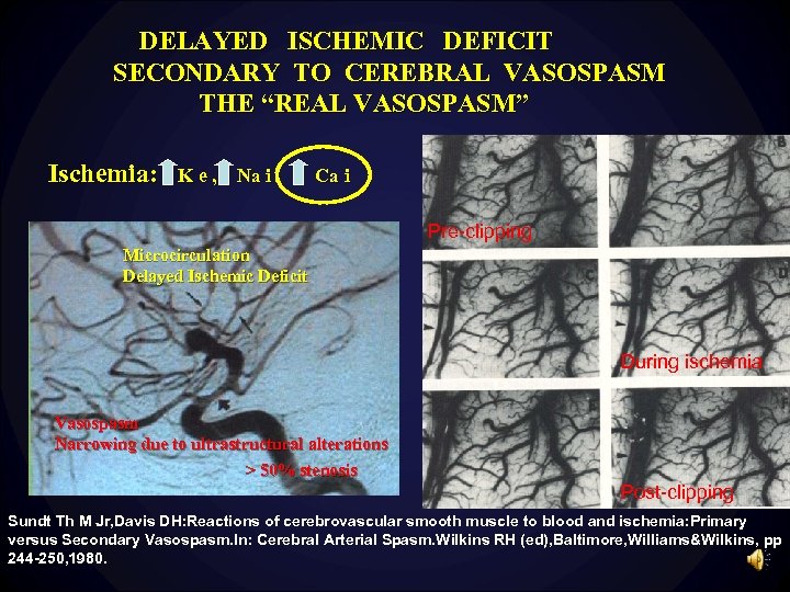 DELAYED ISCHEMIC DEFICIT SECONDARY TO CEREBRAL VASOSPASM THE “REAL VASOSPASM” Ischemia: K e ,