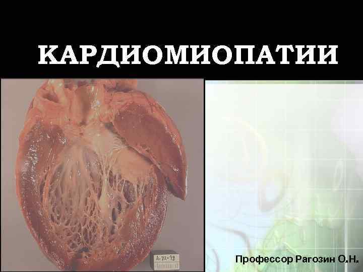 КАРДИОМИОПАТИИ Профессор Рагозин О. Н. 