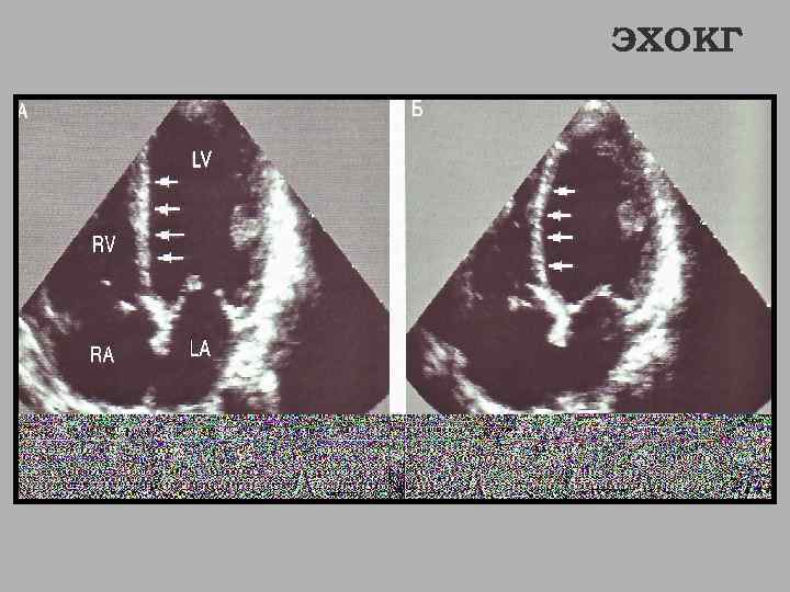 ЭХОКГ 