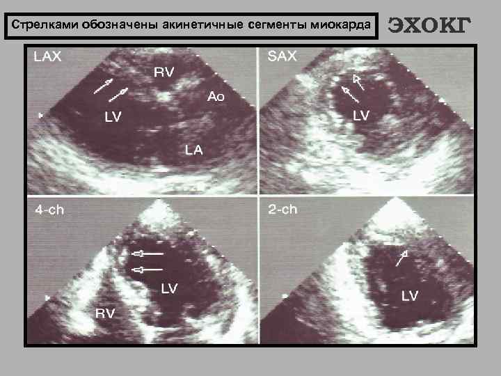 Стрелками обозначены акинетичные сегменты миокарда ЭХОКГ 