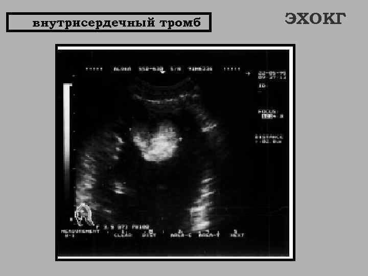 внутрисердечный тромб ЭХОКГ 