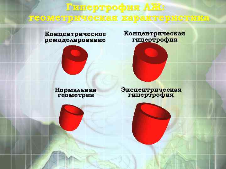 Гипертрофия ЛЖ: геометрическая характеристика Концентрическое ремоделирование Нормальная геометрия Концентрическая гипертрофия Эксцентрическая гипертрофия 