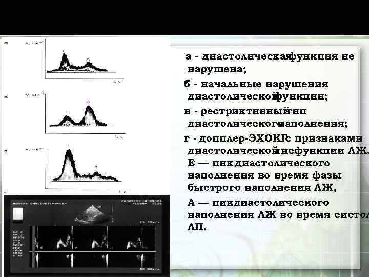 а - диастолическая функция не нарушена; б - начальные нарушения диастолической функции; в -